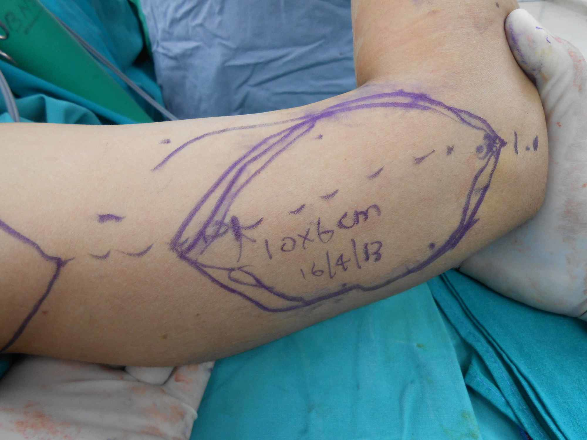 Cureus Lateral Arm Flap Its Usage as Pedicle and Free Flap