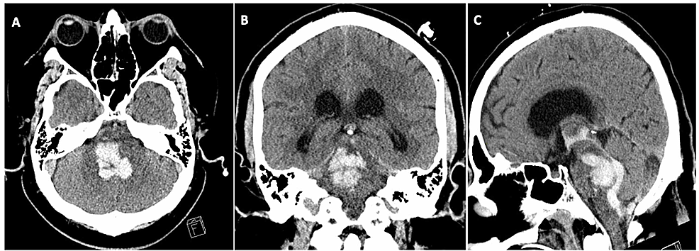 cureus-spontaneous-brainstem-hemorrhagic-stroke-in-the-setting-of