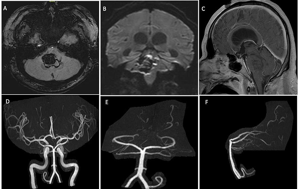 Brain-MRI-with-and-without-contrast-showing-brainstem-hematoma-centered-in-the-pons,-just-to-the-right-of-midline-with-extension-into-the-right-middle-cerebral-peduncle-associated-with-intraventricular-extension