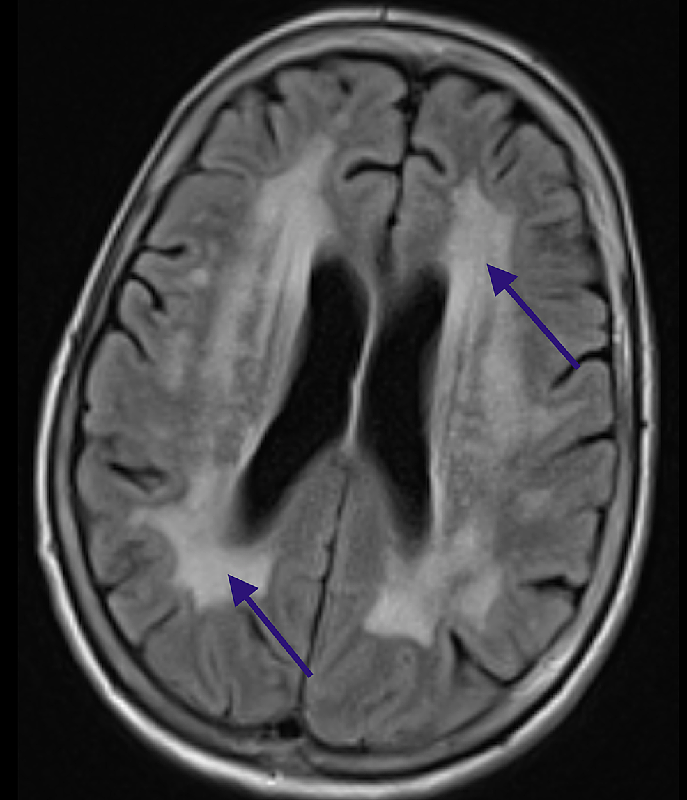 PDF) Microhemorrhage Pathology in Traumatic Brain Injury (TBI): Clinical  and Radiologic Features