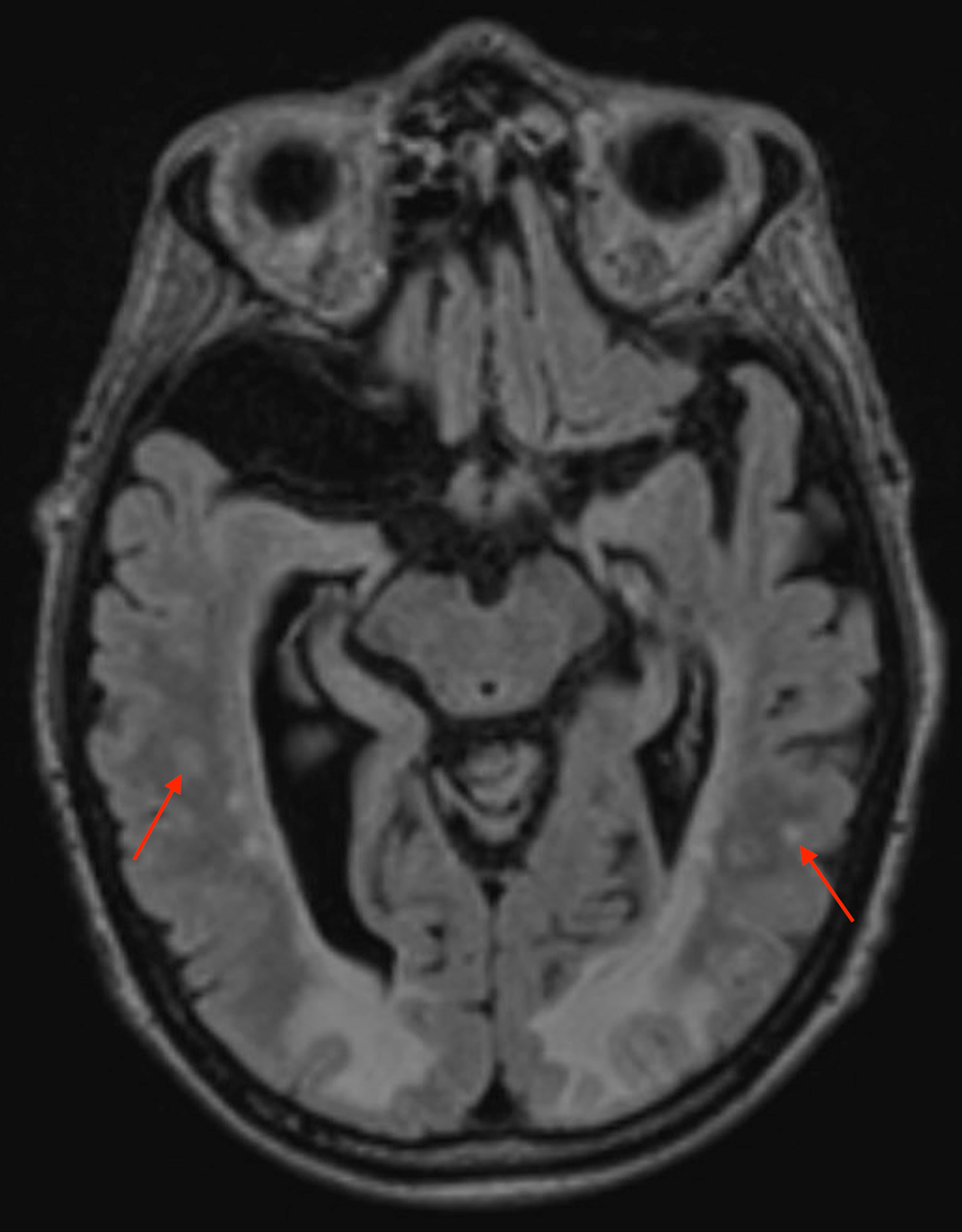 Cureus | An Unexpected Case of Posterior Reversible Encephalopathy Syndrome