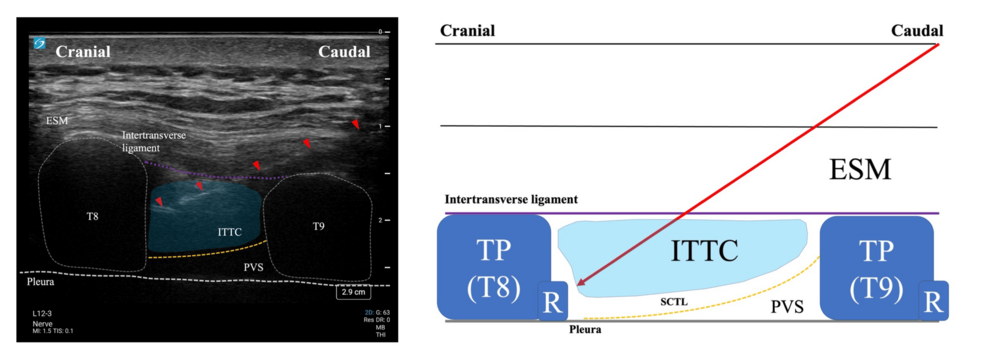 Ultrasound-anatomy-of-the-ITPB.-Ultrasound-image-(left)-and-corresponding-schematic-(right)-of-the-intertransverse-process-block-at-the-T8-T9-level.-The-ultrasound-image-shows-a-parasagittal-view-with-key-anatomical-structures:-ESM,-T8,-and-T9-transverse-processes-(outlined-with-white-dotted-lines),-ITTC (colored-in-light-blue),-PVS,-and-pleural-line.-The-purple-dotted-line-indicates-the-intertransverse-ligament,-while-the-yellow-dotted-line-represents-the-SCTL.-Red-arrowheads-mark-the-needle-trajectory-approaching-from-caudal-to-cranial-direction.-The-light-blue-area-illustrates-the-spread-of-local-anesthetic-within-the-ITTC.-The-schematic-on-the-right-provides-a-simplified-anatomical-representation-of-the-same-structures-to-enhance-understanding-of-the-sonoanatomy-and-needle-path-(red-arrow)-for-the-ITPB-technique