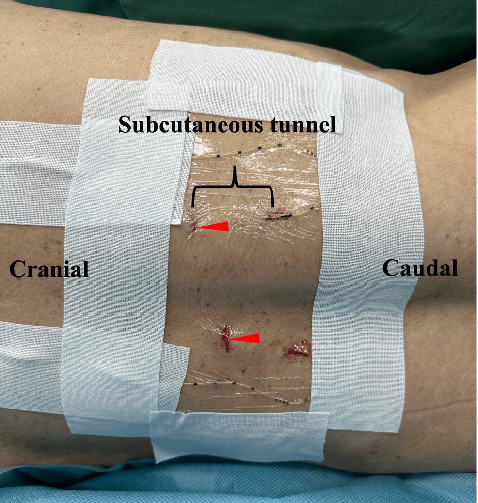 Bilateral-ITPB-catheter-placement-with-subcutaneous-tunneling