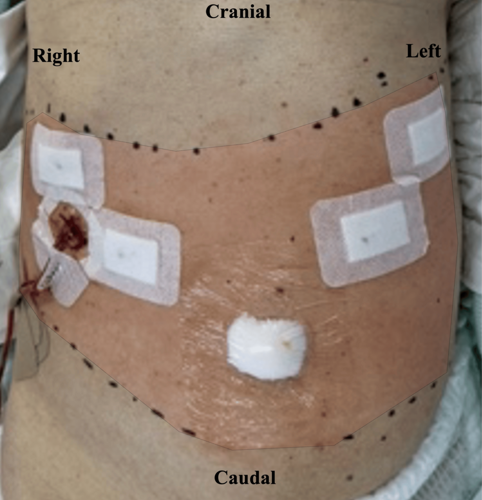 Assessment-of-sensory-blockade-pattern-after-ITPB