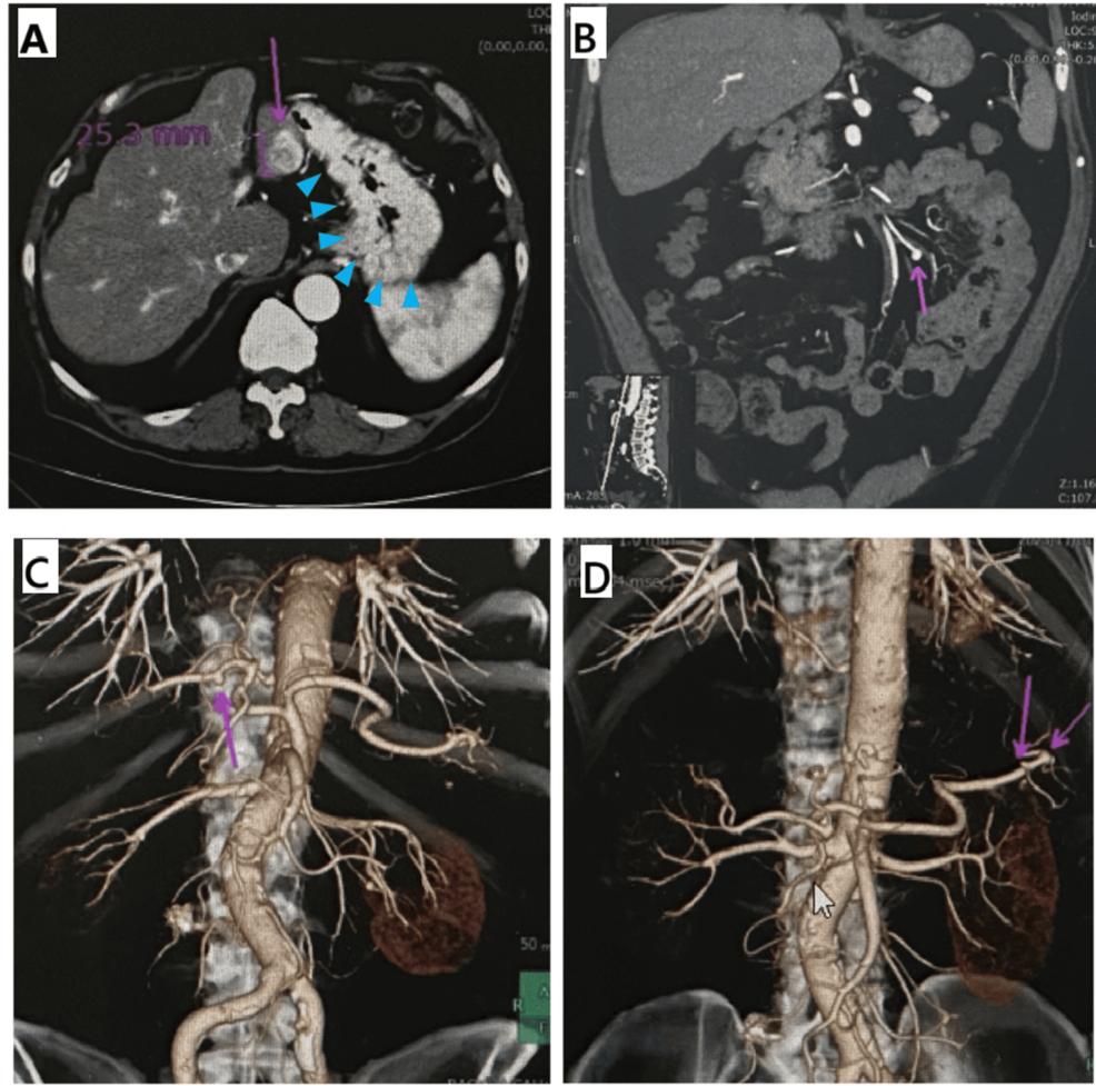 Preoperative-CT-images-demonstrating-HCC-and-vascular-anomalies.-(A)-A-25-mm-early-enhancing-lesion-in-liver-segment-3-suggestive-of-HCC (purple-arrow)-and-gastric-varices-(blue-arrowheads).-(B)-Mesenteric-arterial-aneurysm-(purple-arrow).-(C)-Right-hepatic-arterial-aneurysm-(purple-arrow).-(D)-Multiple-aneurysms-in-the-distal-arterial-trunk-(purple-arrows).-These-images-demonstrate-the-extensive-vascular-abnormalities-associated-with-the-patient's-portal-hypertension