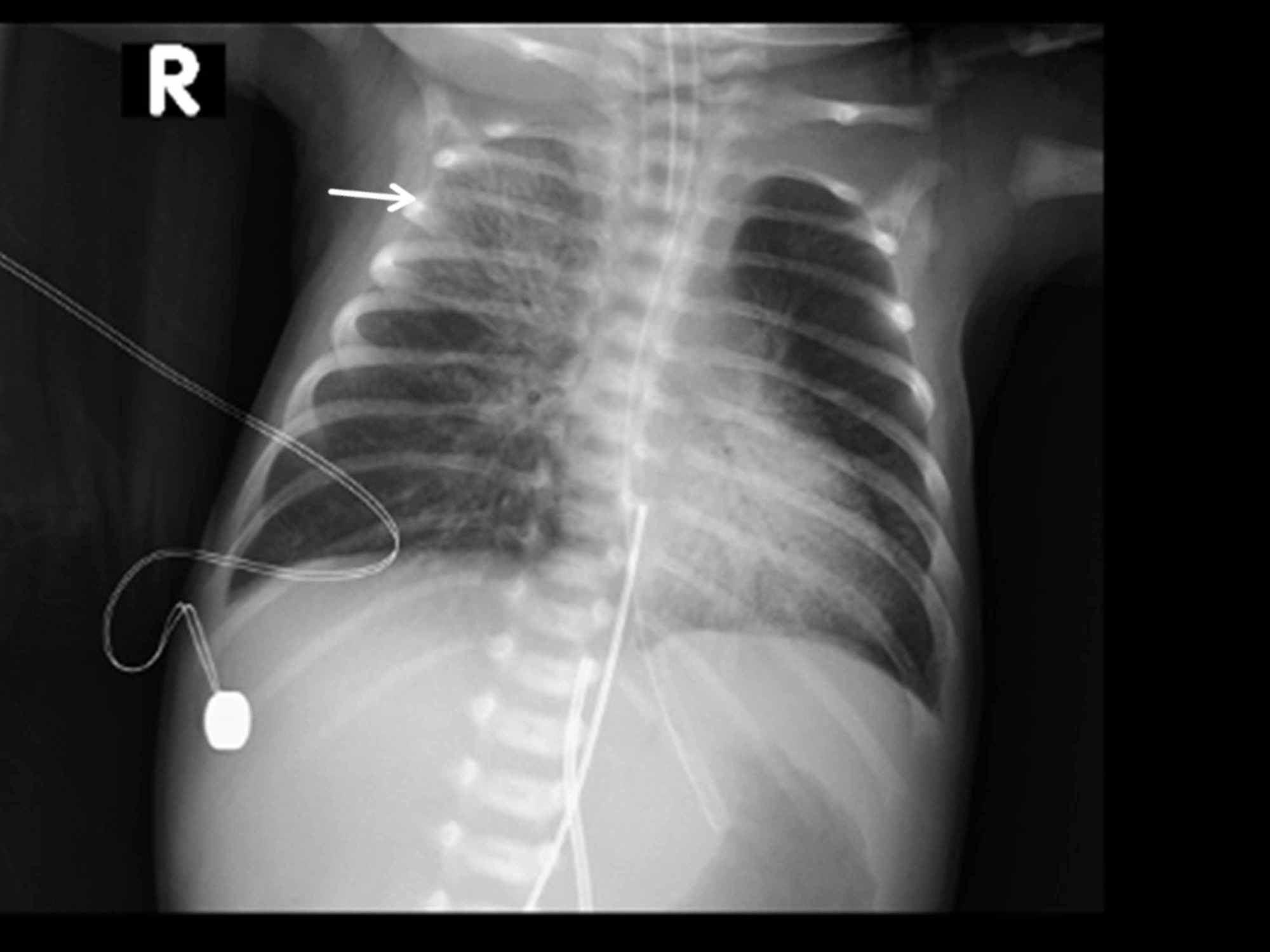 Cureus | A Novel Case of Severe Respiratory Symptoms and Persistent ...