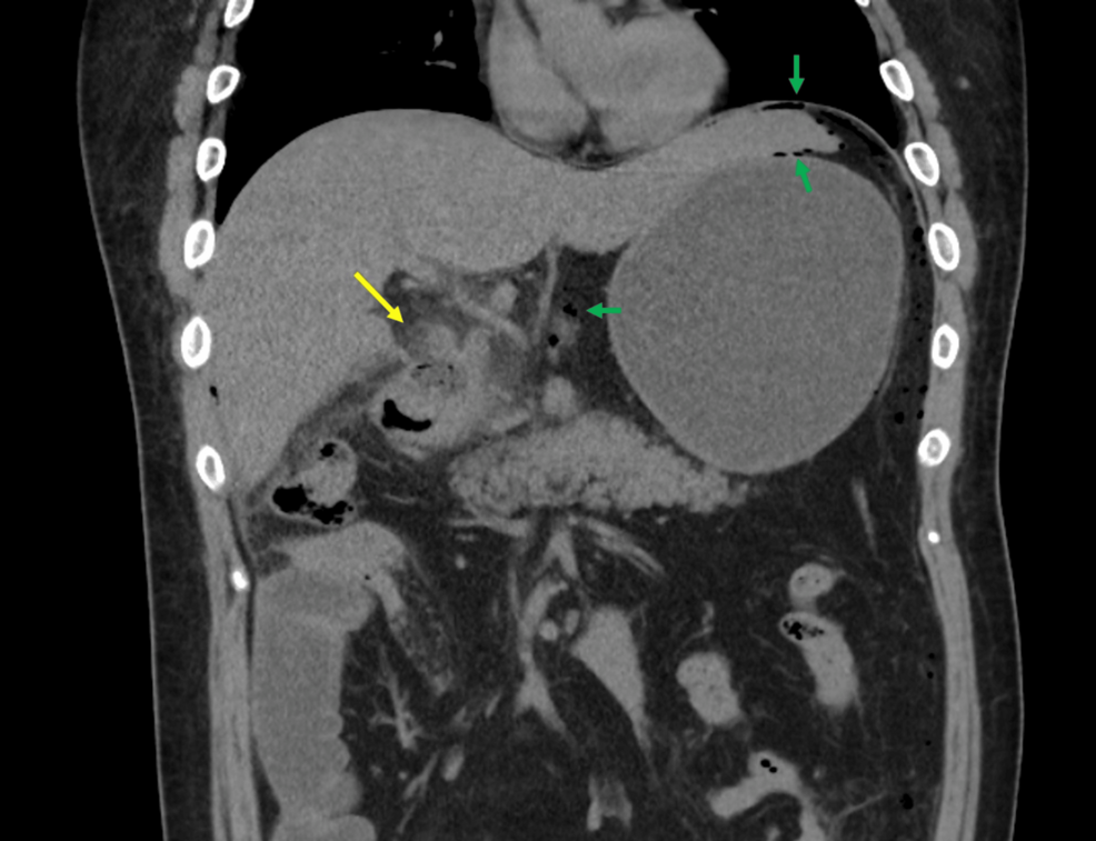 can tirzepatide cause ulcers Acute Duodenal Ulcer Perforation Following Tirzepatide Treatment: A Case  Report