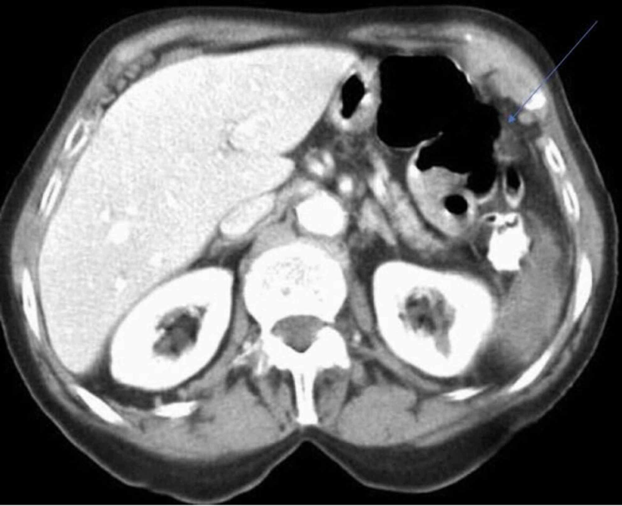 Cureus Conservative Treatment Of Splenic Haematoma After Colonoscopy A Case Report 4956