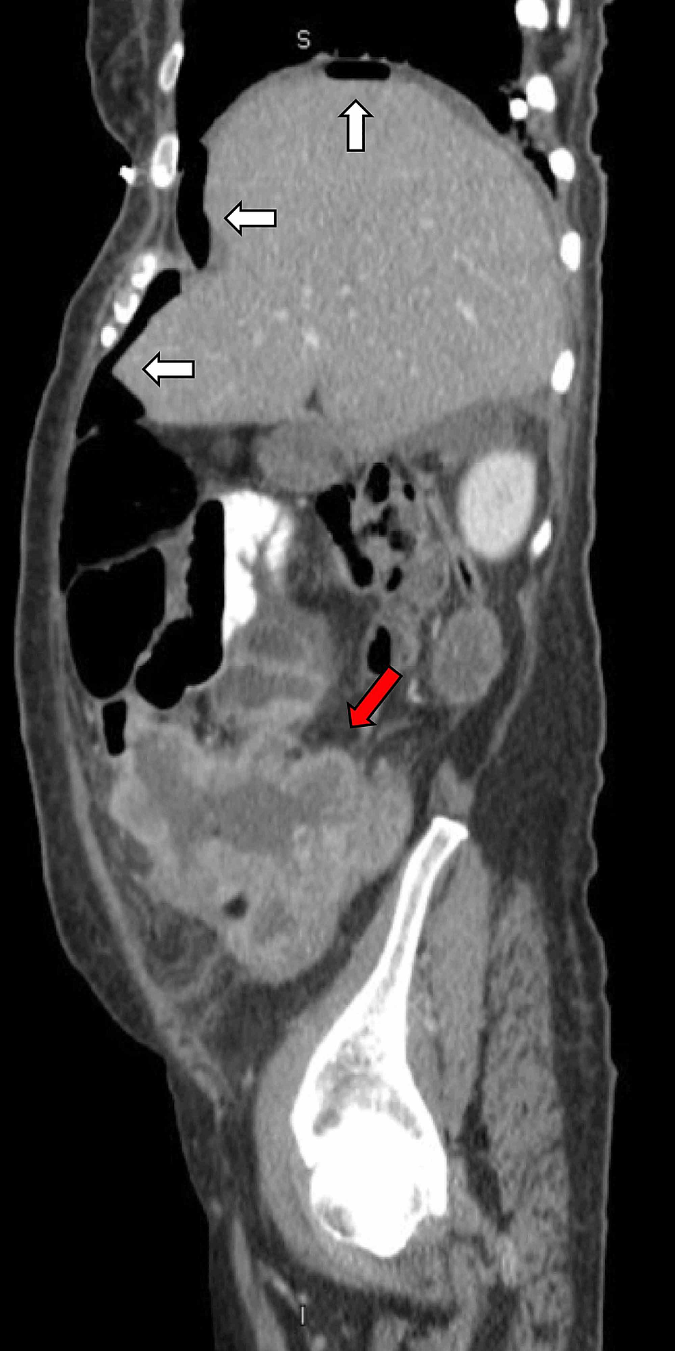 Cureus | Primary Squamous Cell Carcinoma of the Cecum Presenting as ...