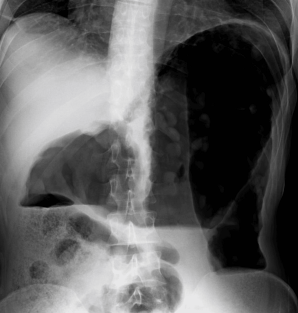Clozapine-Induced Toxic Megacolon: A Rare but Serious Complication