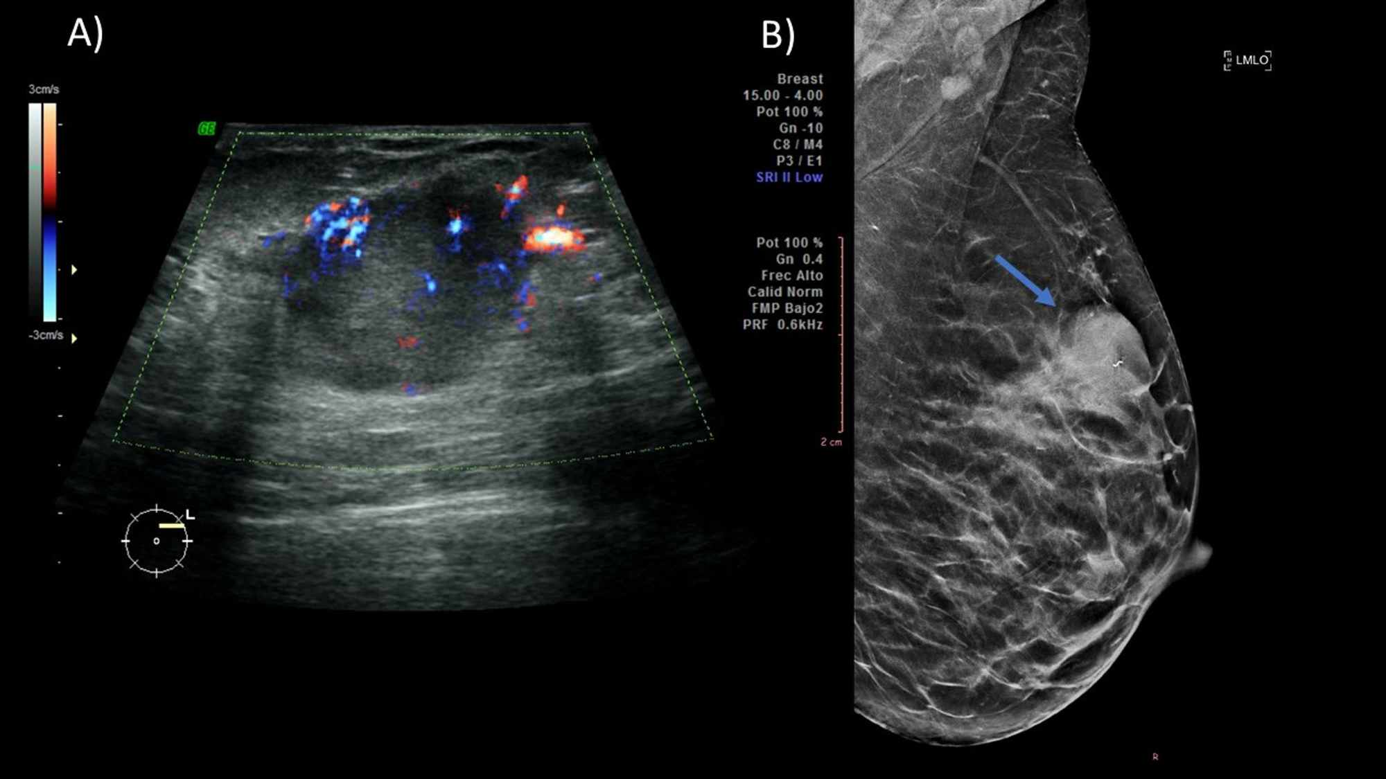 Cureus PregnancyAssociated Breast Cancer What Radiologists Must Know