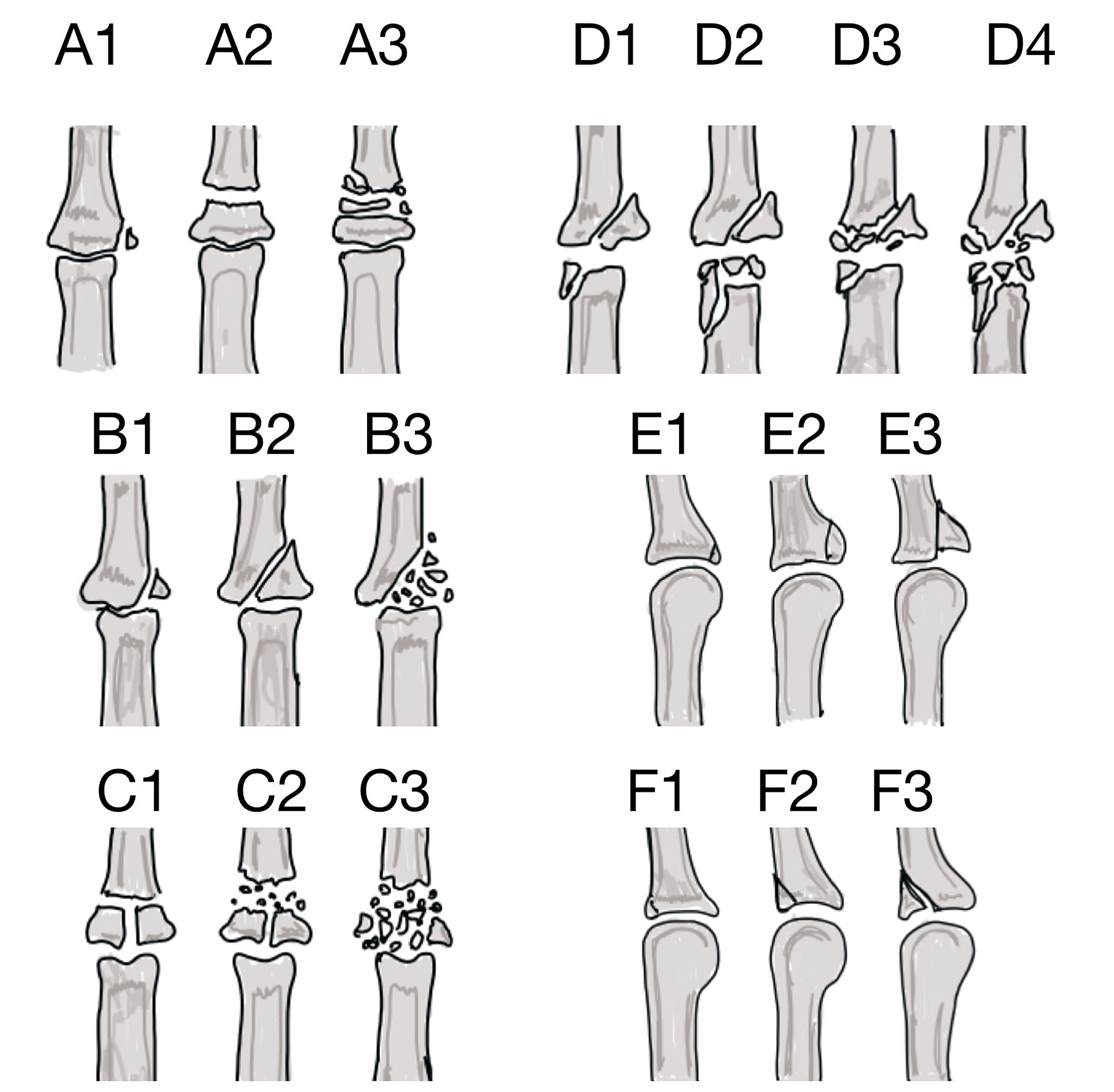 Six Types Of Fractures 6598