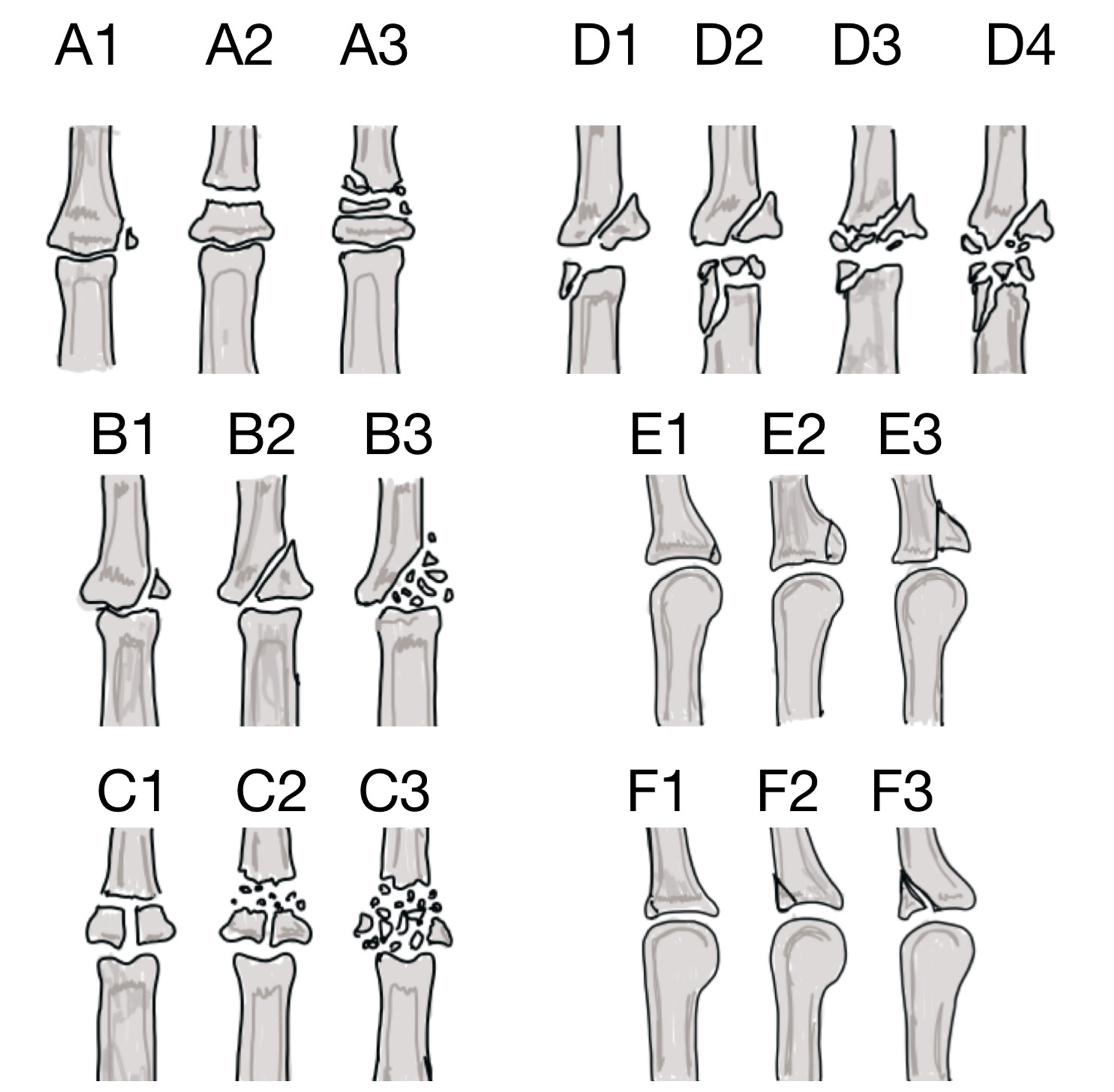 Cureus MidTerm of Unstable Complex Proximal Interphalangeal Joint Fracture