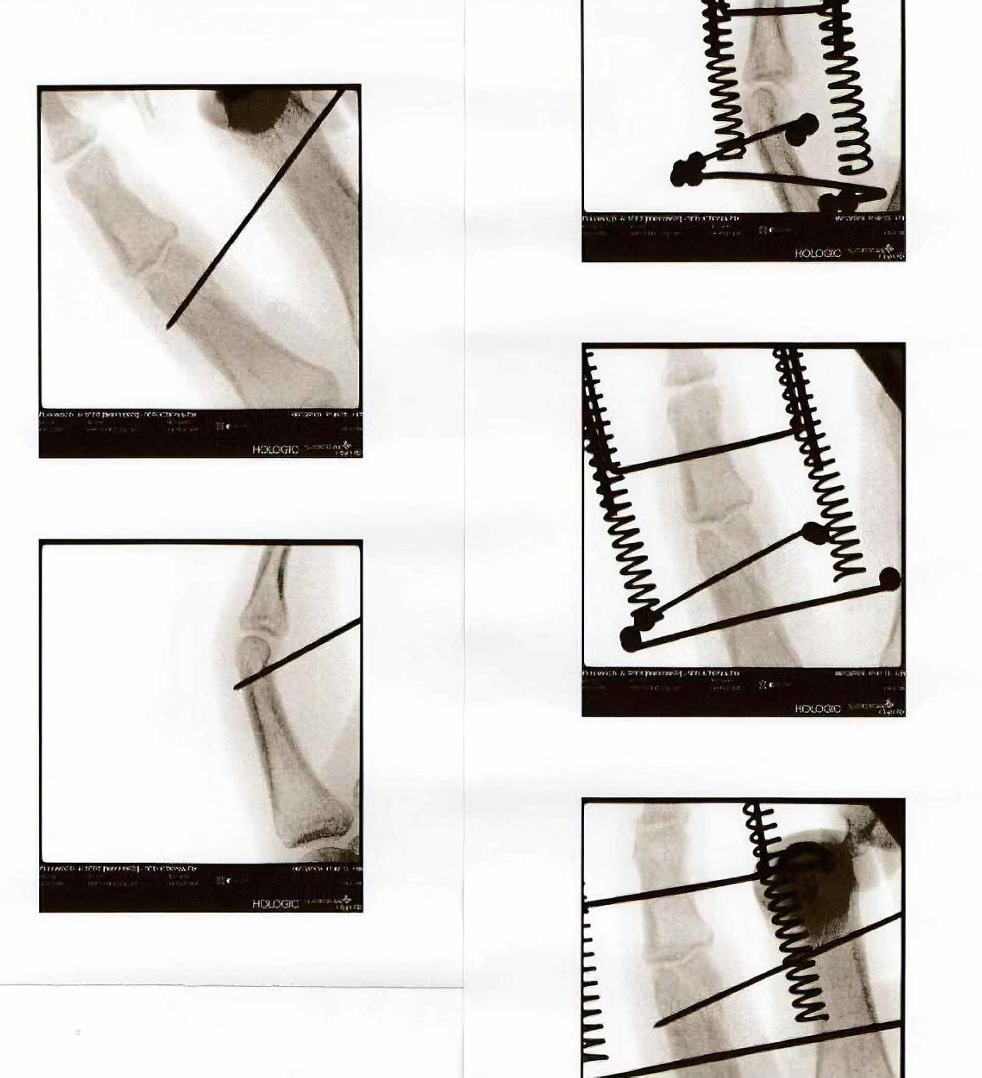 Cureus MidTerm of Unstable Complex Proximal Interphalangeal Joint Fracture