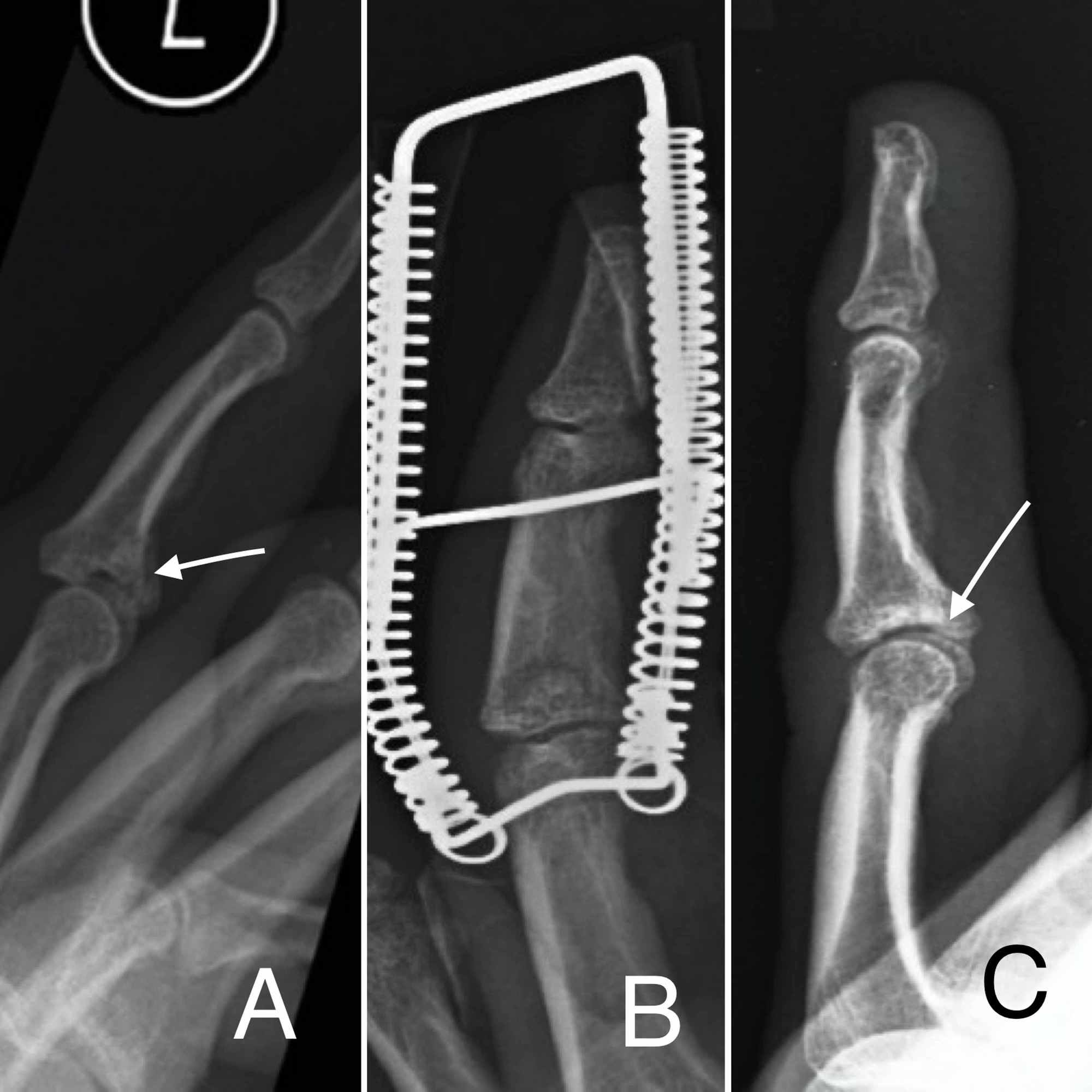 Cureus MidTerm of Unstable Complex Proximal Interphalangeal Joint Fracture