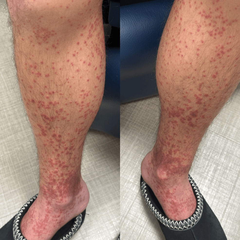 Infectious‐mononucleosis‐like exanthema associated with COVID‐19 in a child  - Ferjani - 2021 - Clinical Case Reports - Wiley Online Library, image size:986x986