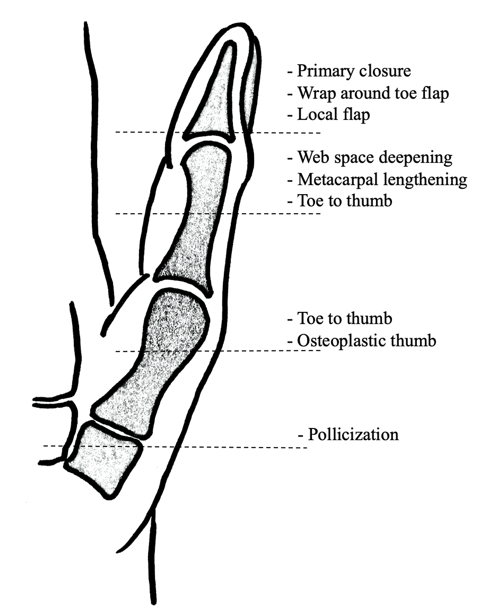 Cureus Pollicization of Long Finger After Traumatic Amputation of