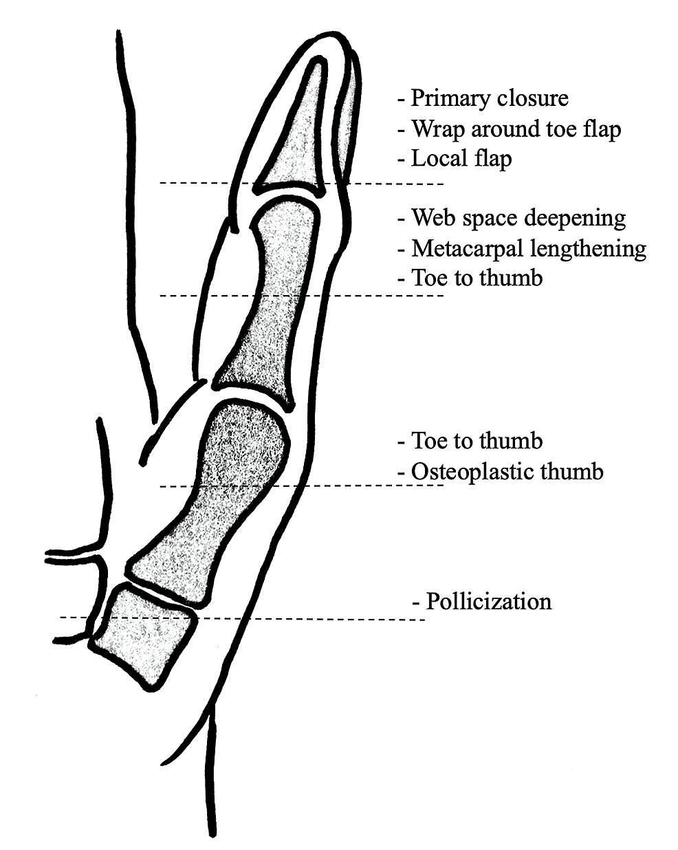Cureus Pollicization of Long Finger After Traumatic Amputation of