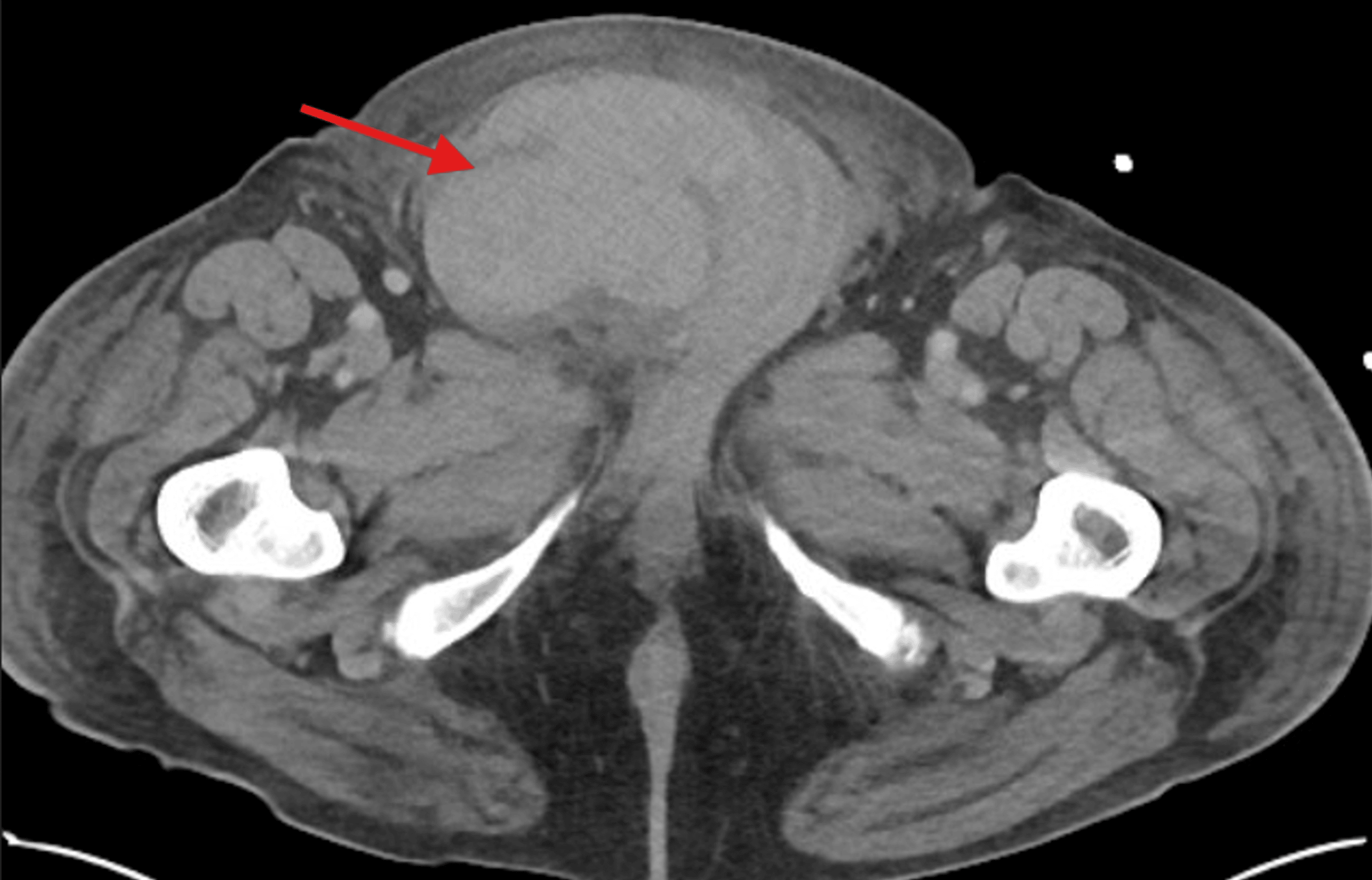 Figure 1: Hematoma formation within the distal right inguinal canal (red arrow)