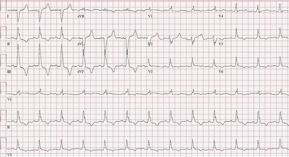 Cureus | Incomplete Trifascicular Block and Mobitz Type II ...