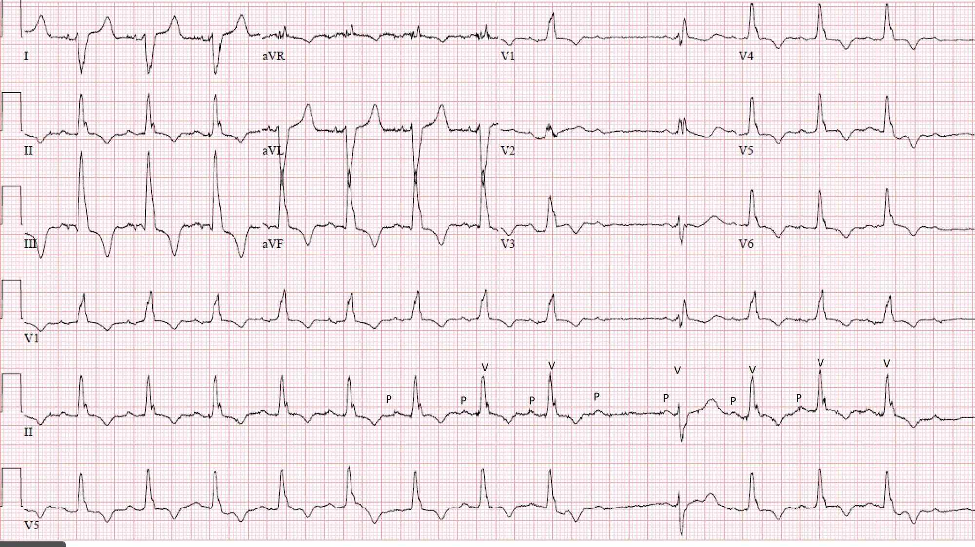 Cureus Trifascicular Block and Mobitz Type II Atrioventricular Block in COVID19