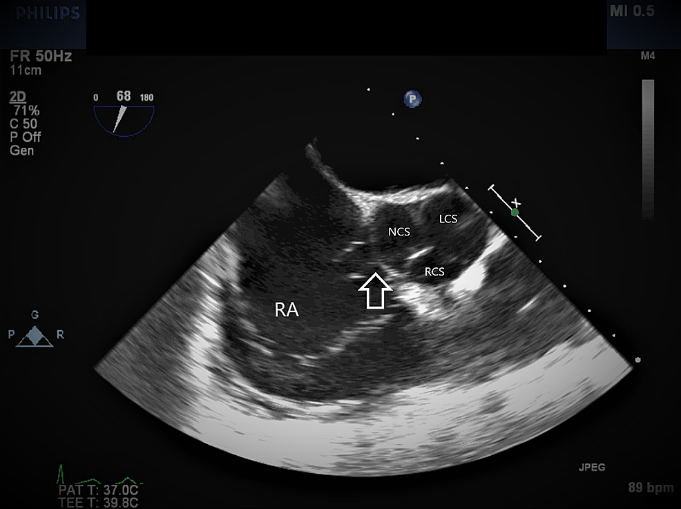 cureus-a-short-case-report-on-ruptured-sinus-of-valsalva-aneurysm