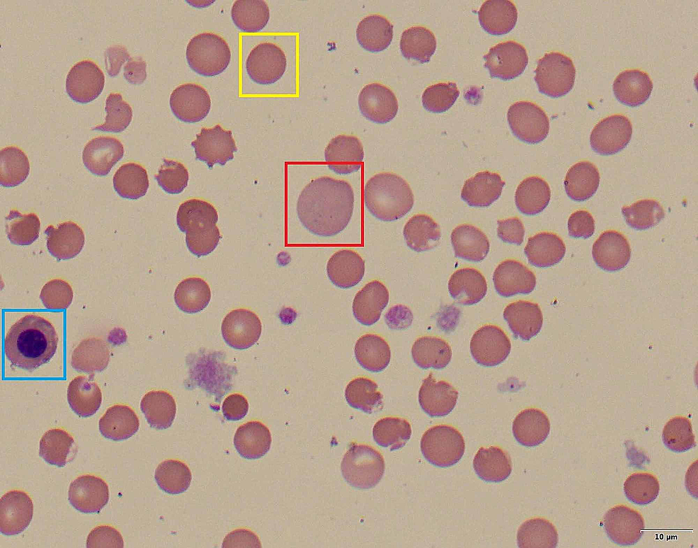 Cureus Glucose6Phosphate Dehydrogenase DeficiencyAssociated