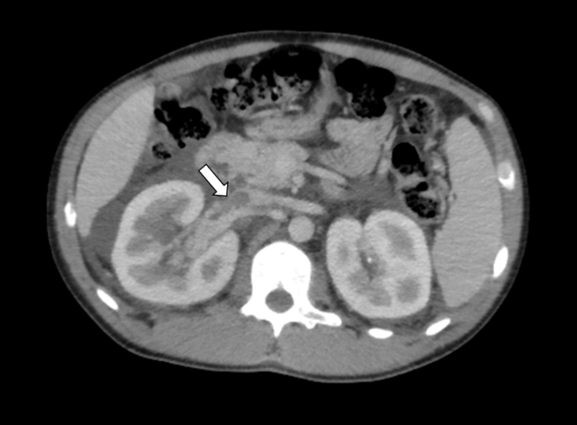 Cureus | Macroscopic Hematuria as the Initial Presentation of ...