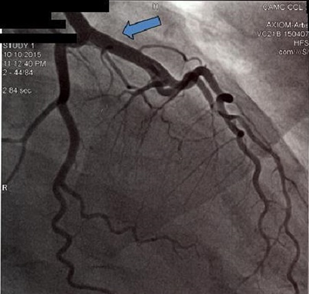 Emergent-angiogram-performed-within-first-few-hours-of-presentation-showed-patent-left-main-coronary-artery.