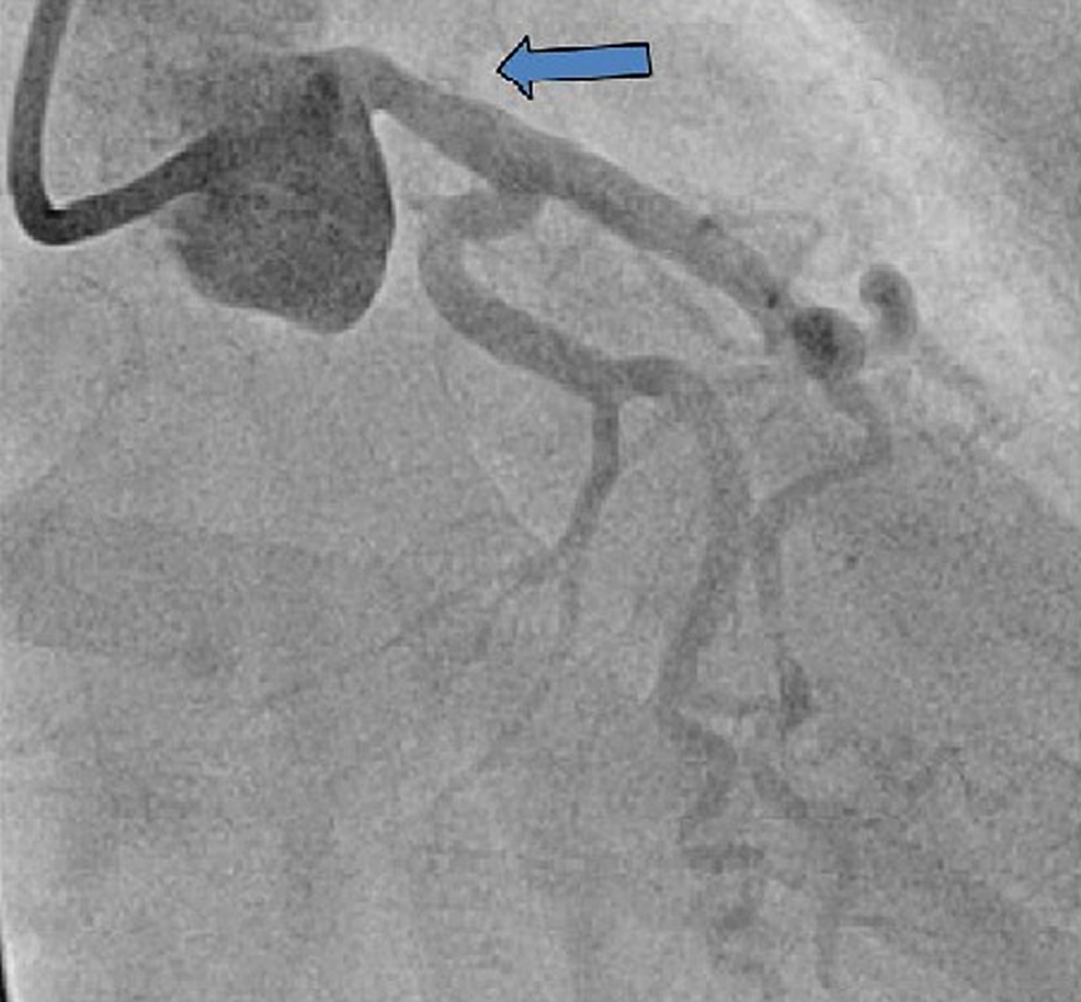 Second-coronary-angiogram-revealed-local-dissection-of-mid-to-distal-left-main-coronary-artery-that-was-not-present-on-previous-angiogram.