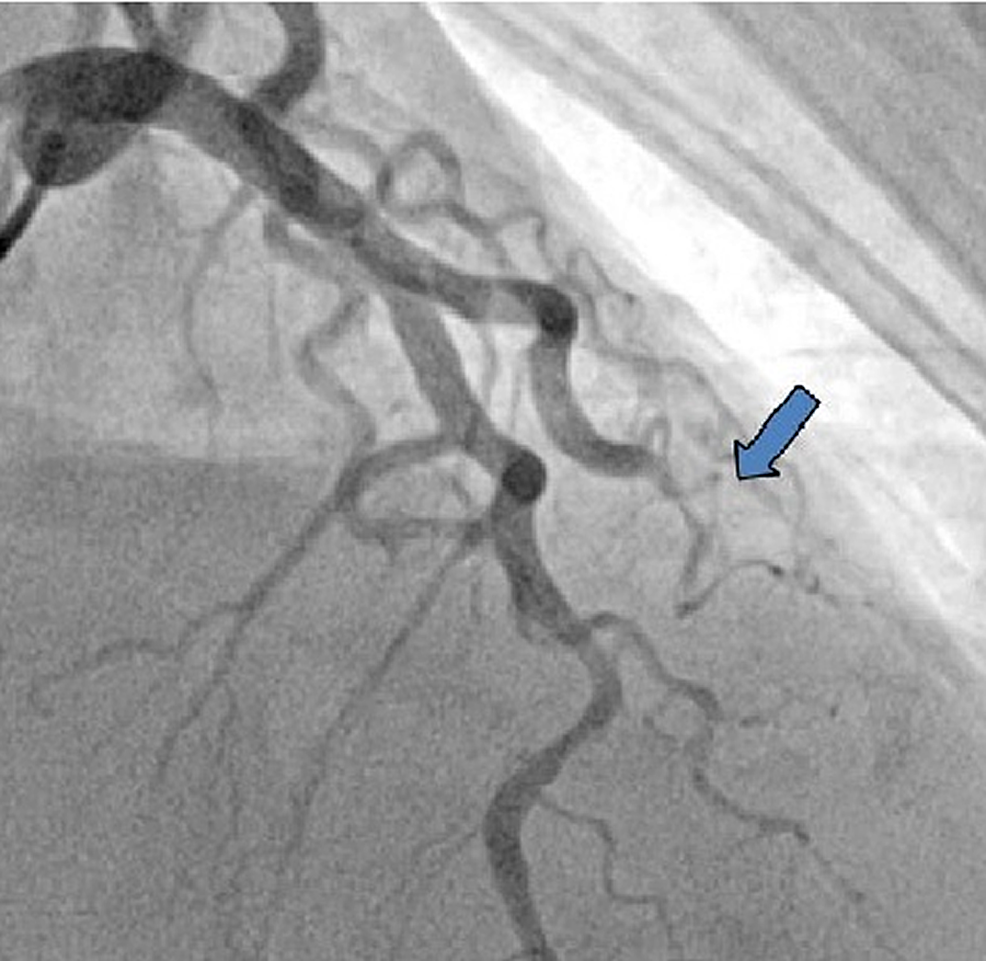 Second-angiogram-showed-total-occlusion-of-diagonal-artery-that-was-patent-on-previous-angiogram.