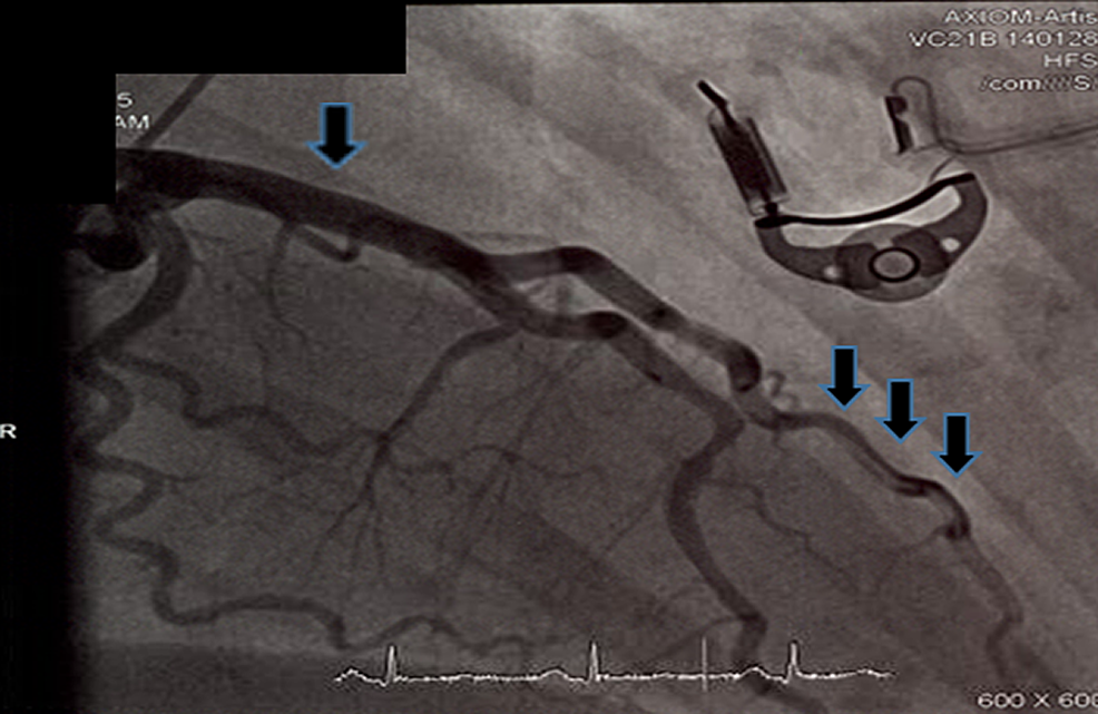 Third-coronary-angiogram-showed-spontaneous-resolution-of-left-main-coronary-artery-dissection-and-long-linear-dissection-of-diagonal-artery.