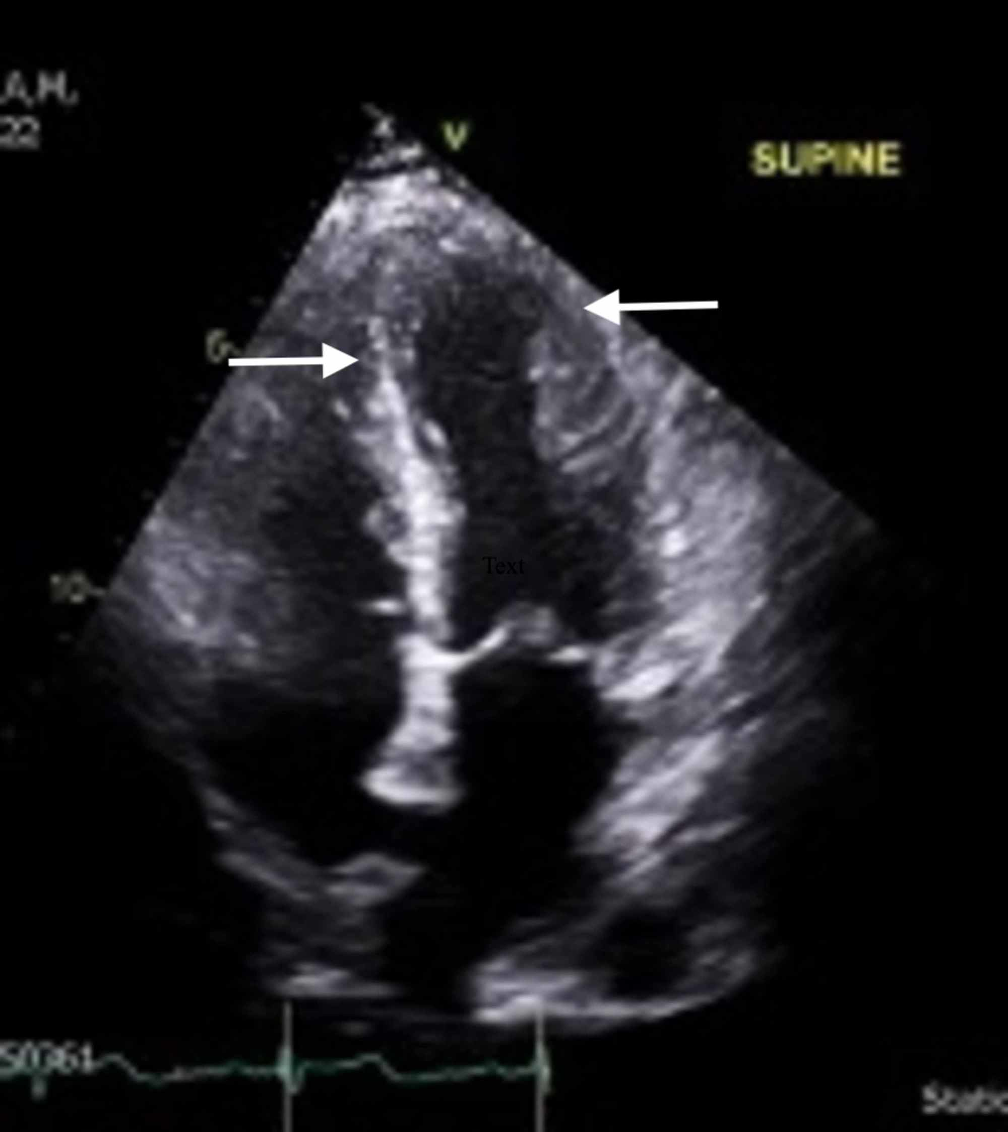 Cureus | Seizure-Associated Takotsubo Cardiomyopathy