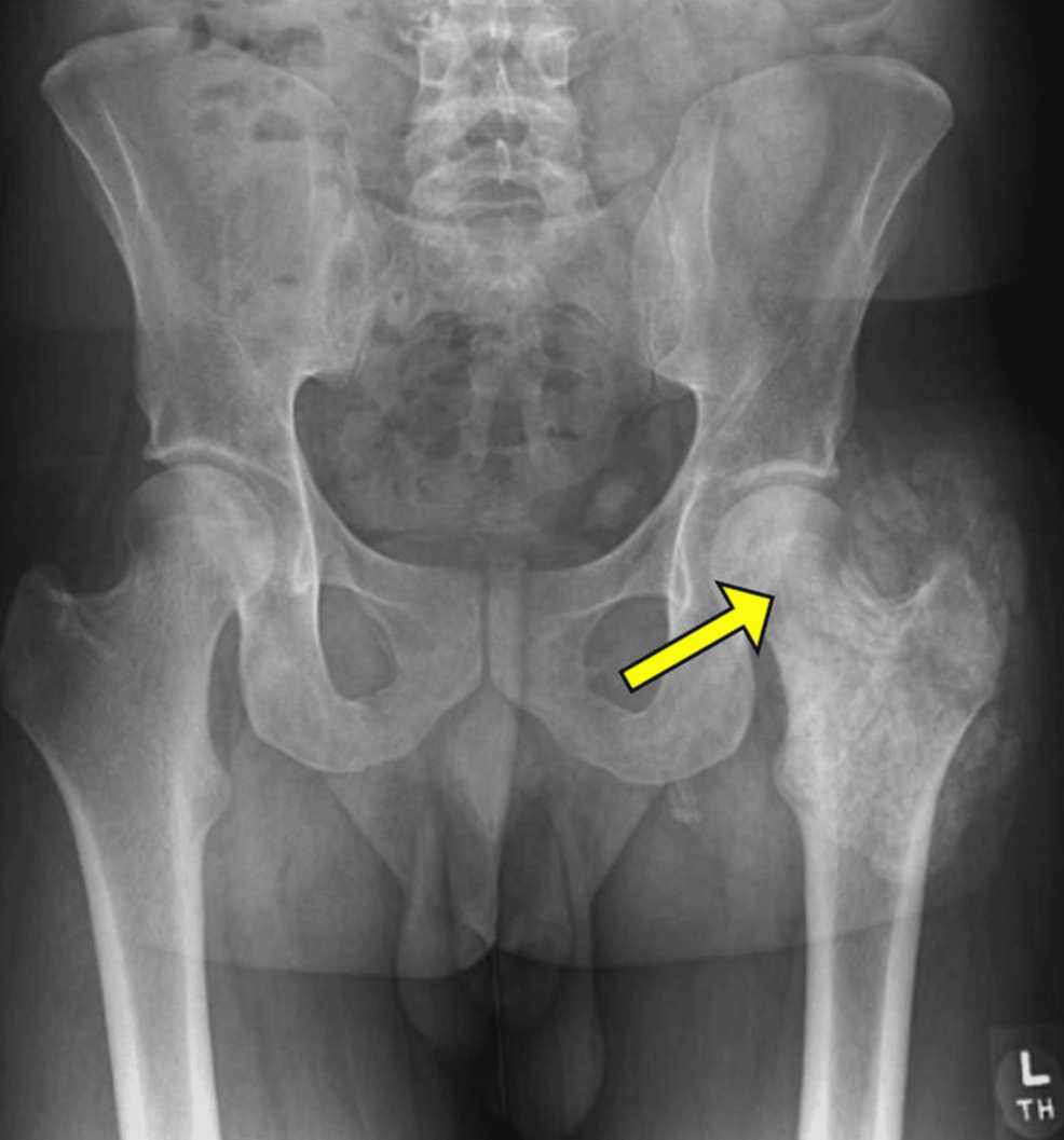 Hyperphosphatemic Familial Tumoral Calcinosis With a Large Hip Mass | Cureus