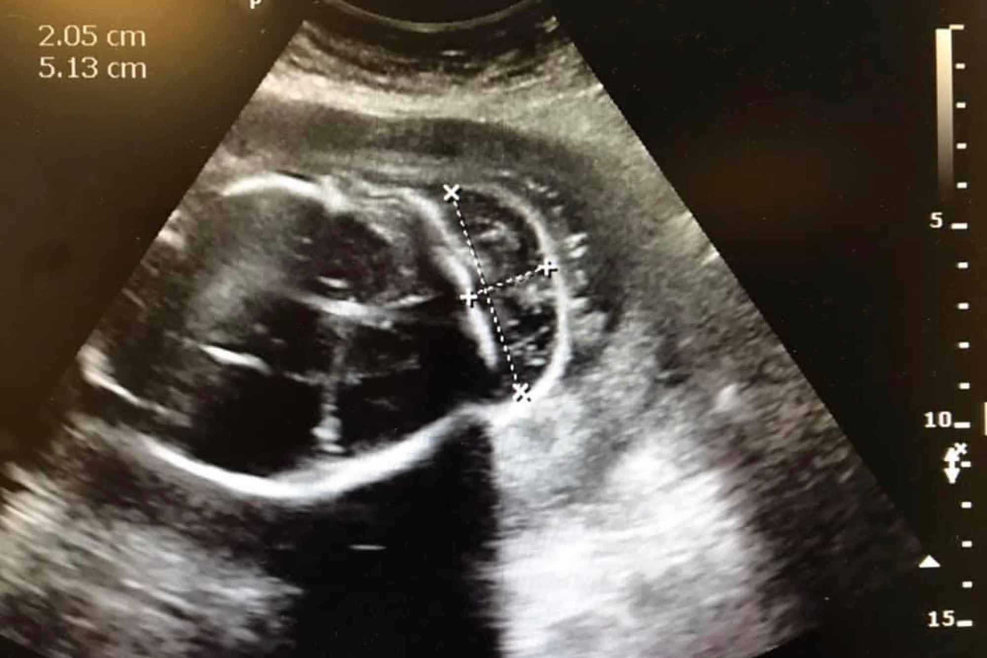 Cureus Congenital Central Nervous System Malformations A Rare Case Of An Encephalocele And 0283