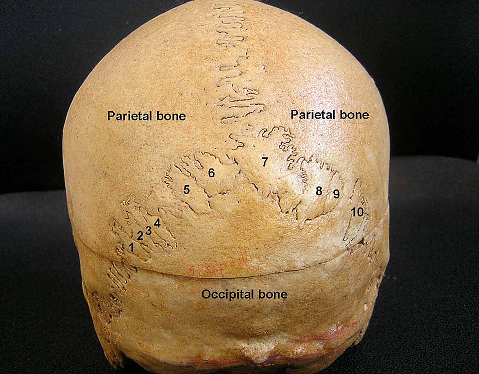 Wormian Bones Examples