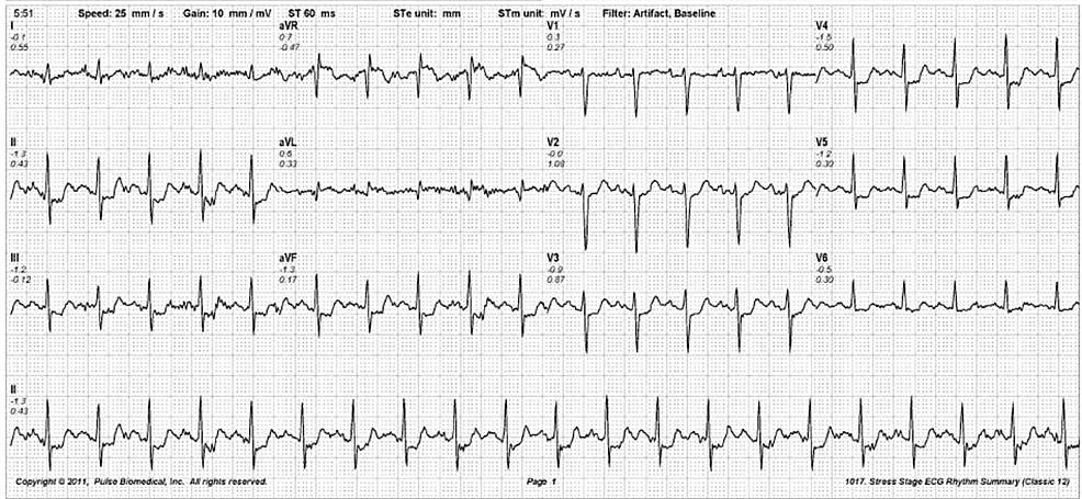 Cureus | Multi Vessel Coronary Artery Disease Presenting as a False ...