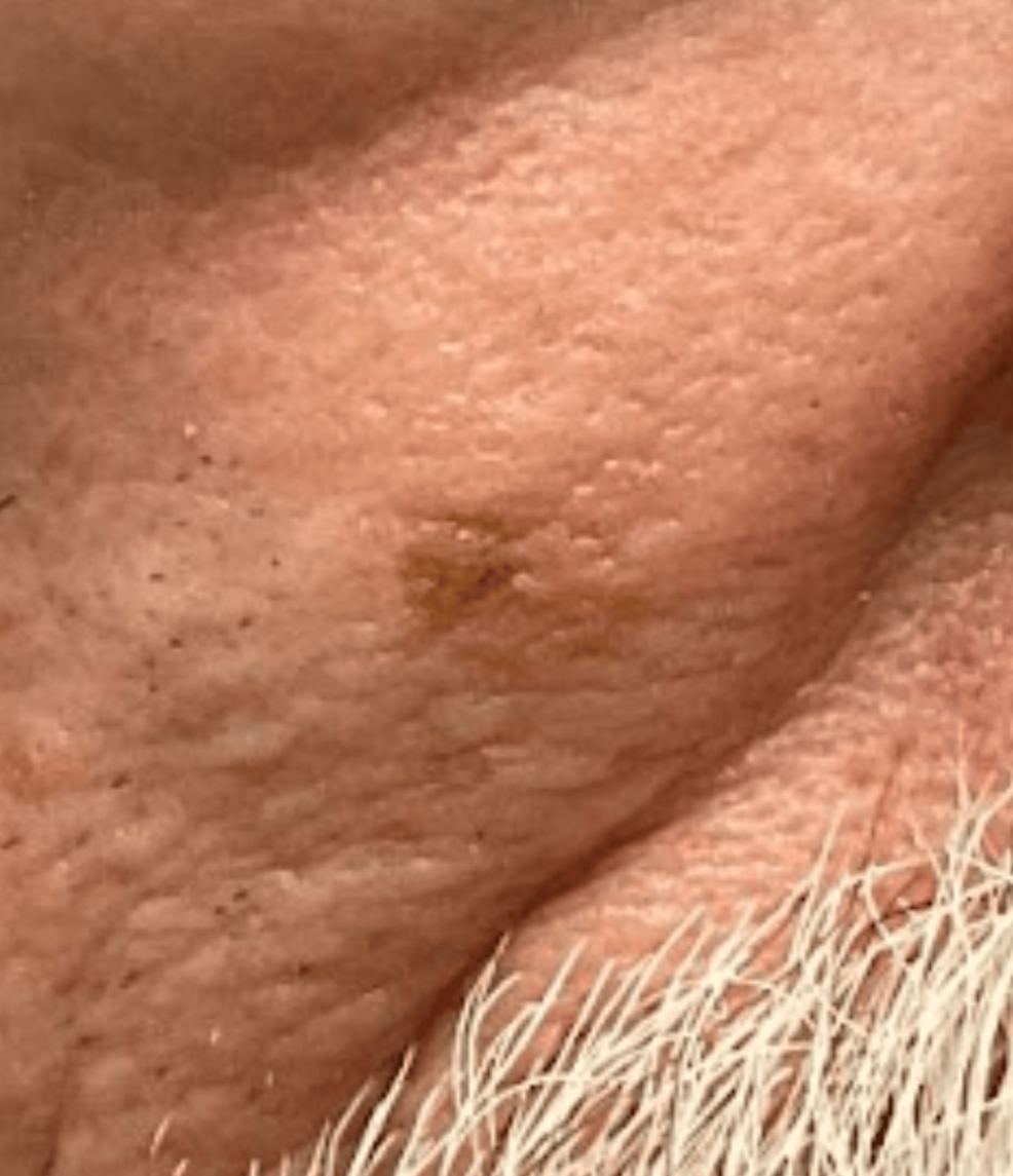 melanotan hvor ofte Nexa Med Spa