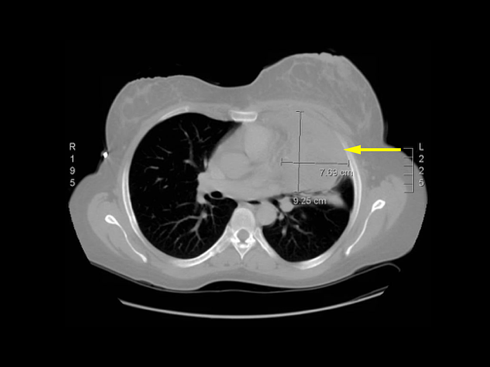 Cureus  Polyparaneoplastic Manifestations of Malignant 