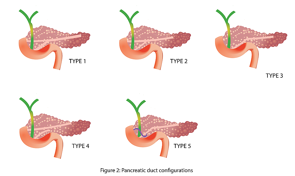 Pancreatic-duct-configurations