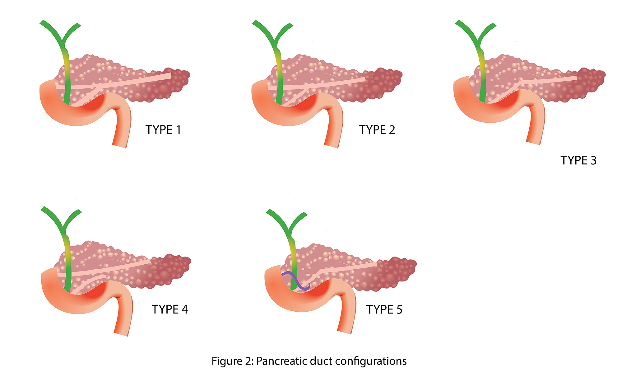 Cureus | Pancreatic Duct Variations and the Risk of Post-Endoscopic