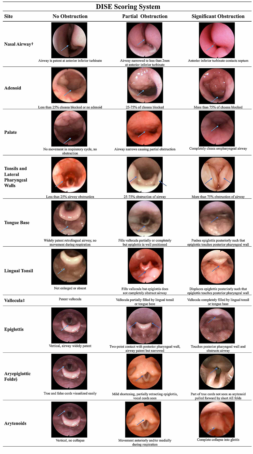 Cureus Pediatric DrugInduced Sleep Endoscopy Technique and Scoring