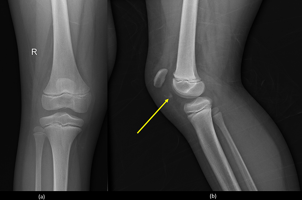 Xray Knee Aplateral Showing Fracture Patella Or Knee Cap