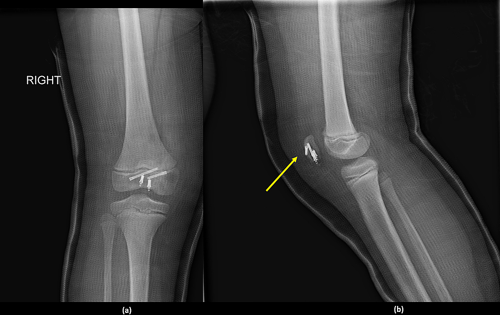 Cureus | Patellar Sleeve Fracture in an Eight-Year-Old Girl