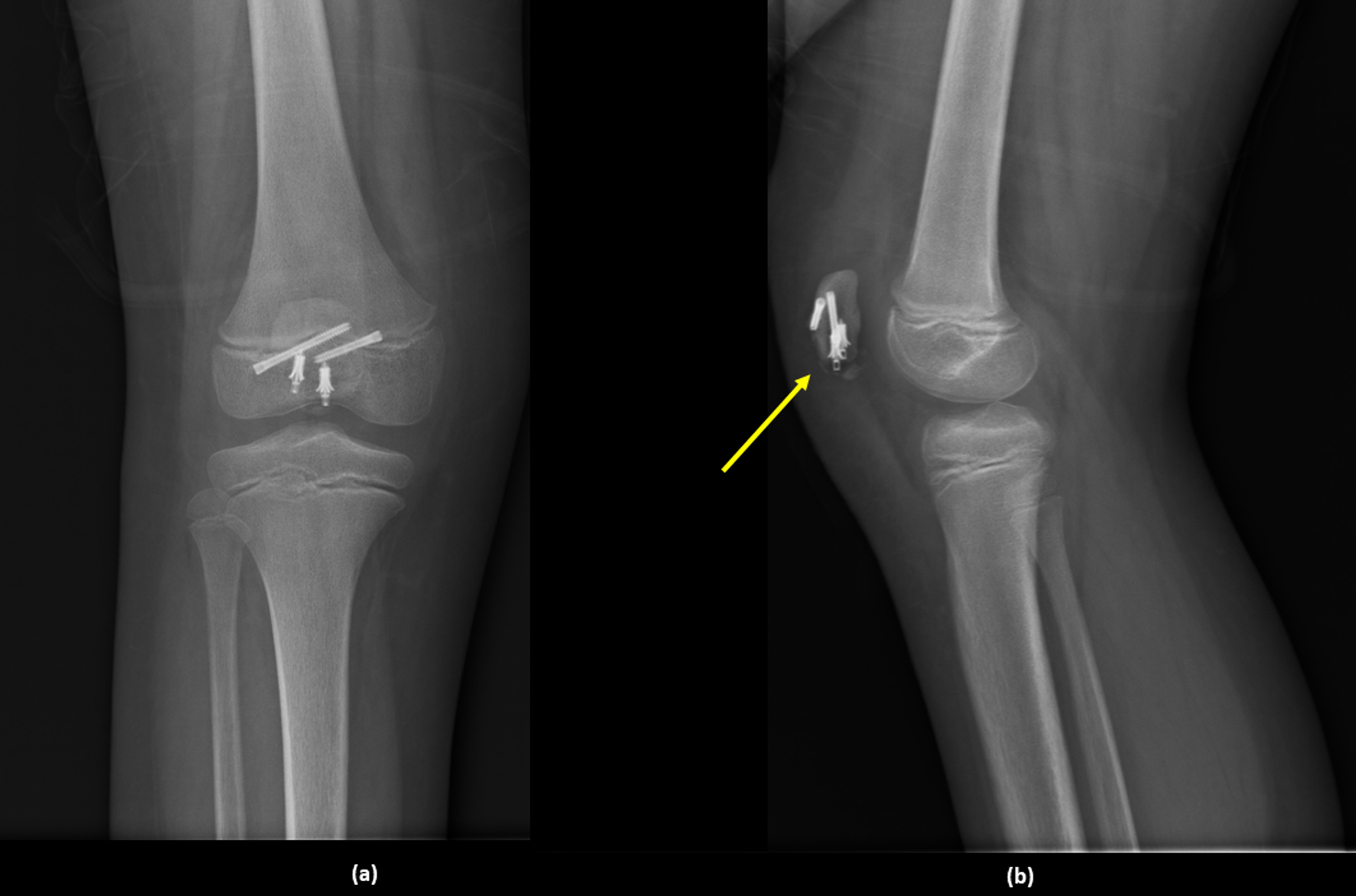 Cureus | Patellar Sleeve Fracture In An Eight-Year-Old Girl