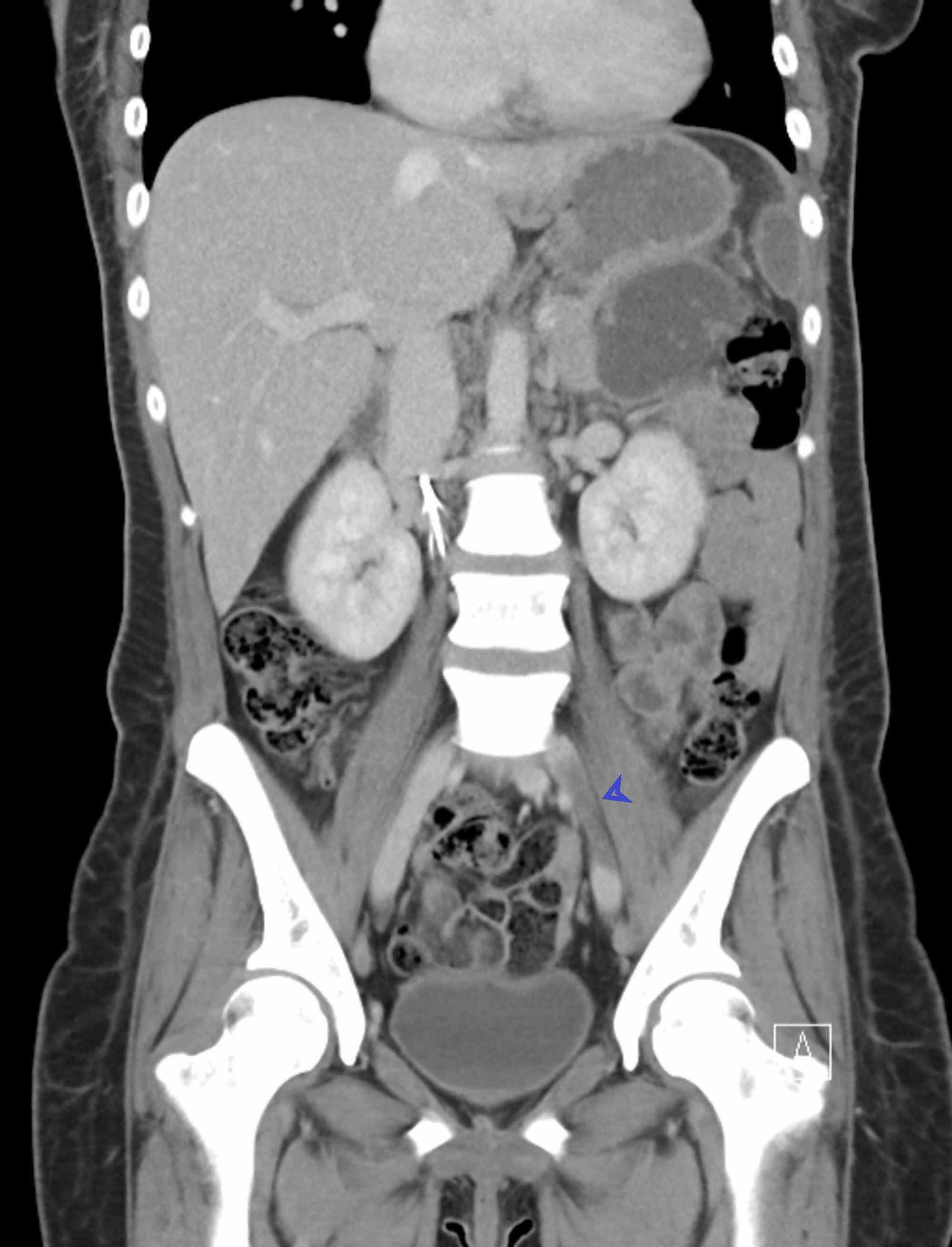 Cureus | A Case Of May-Thurner Syndrome