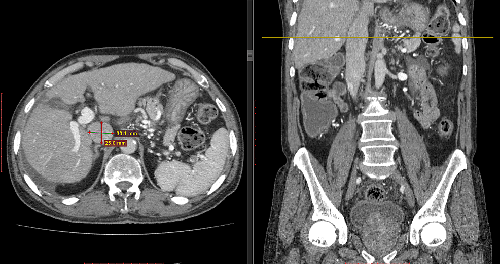 Cureus Idiopathic Dilatation of Inferior Vena Cava A Case Report