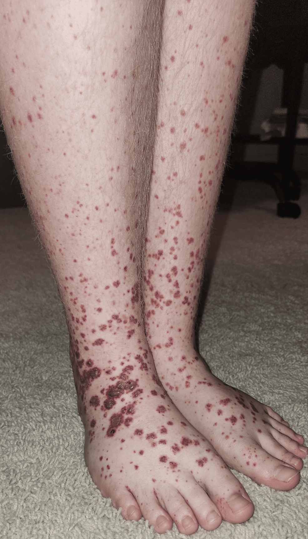 Henoch-Schönlein Purpura Without Proven Immunoglobin A Deposition: A Diagnostic Distinction | Cureus