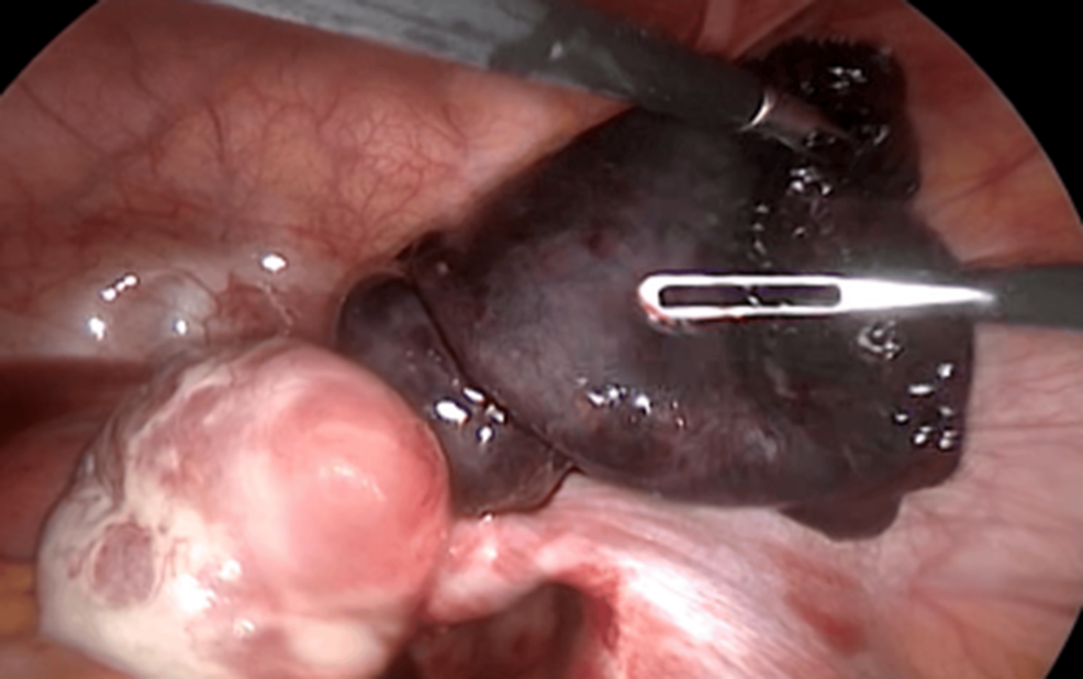 Doctors thought the pain was endometriosis. After laparoscopic surgery I  turned into a 1 in 1.5 million patient! Ovarian torsion/twisted fallopian  tubes. Pictures of twisted tubes added if you're curious. : r/endometriosis, image size:986x618