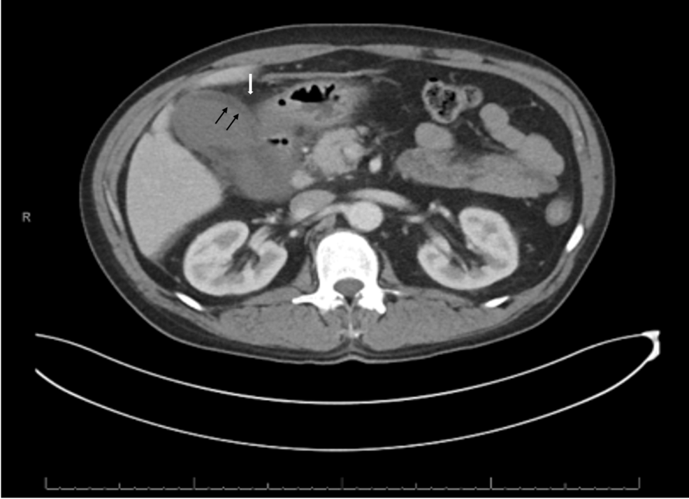 Gangrenous Cholecystitis in a 54-Year-Old Male With Schizophrenia and Other Barriers to Care: A Case Report